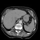 Calcifications in spleen, miliary calcifications, tuberculosis: CT - Computed tomography